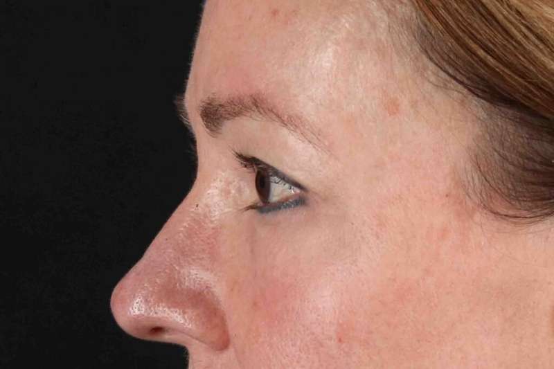 Laser Before & After Patient #2114