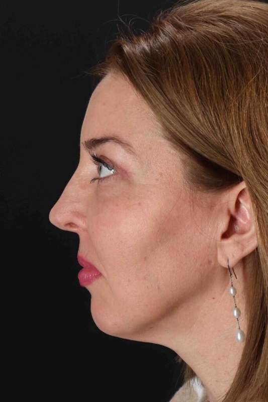 Laser Before & After Patient #2136
