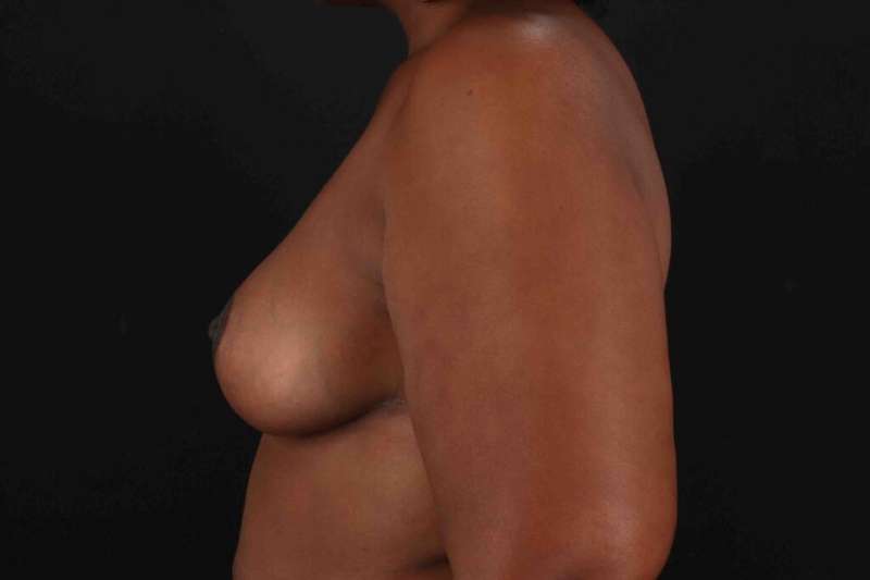 Breast Reduction with Lift Before & After Patient #917