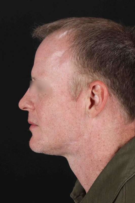 Laser Before & After Patient #2158
