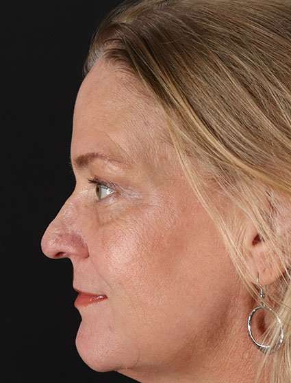 Chemical Peel Before & After Patient #2169