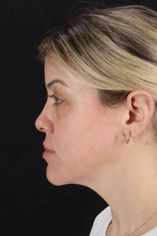 Chemical Peel Before & After Patient #2180