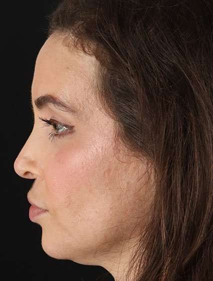 Chemical Peel Before & After Patient #2202