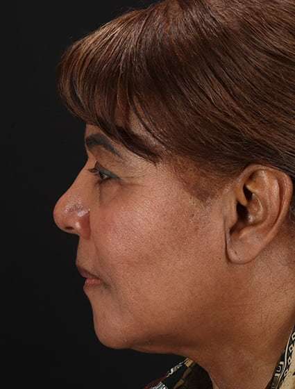 Chemical Peel Before & After Patient #2227