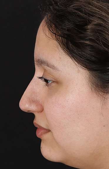 Cosmetic Injectables Before & After Patient #2253