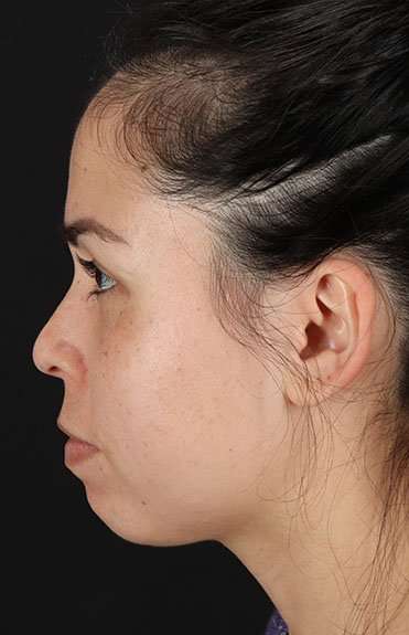 Cosmetic Injectables Before & After Patient #2264