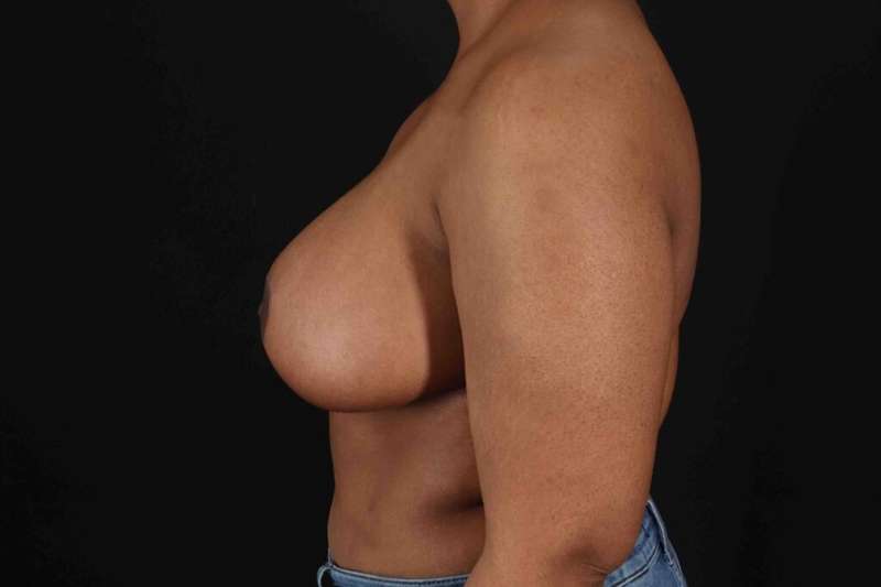 Breast Reduction with Lift Before & After Patient #928