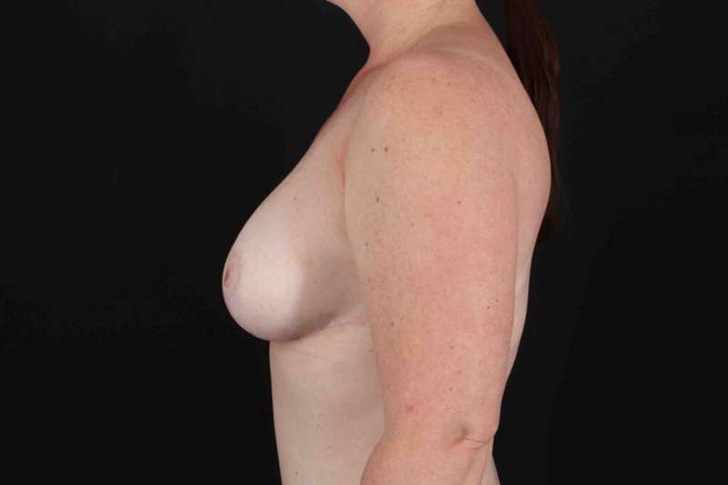 Breast Reduction with Lift Before & After Patient #950