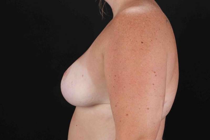 Breast Reduction with Lift Before & After Patient #961