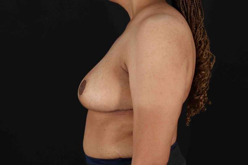 Breast Reduction with Lift Before & After Patient #1005