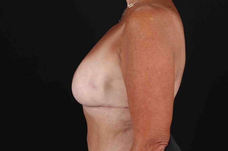 Breast Reduction with Lift Before & After Patient #1016