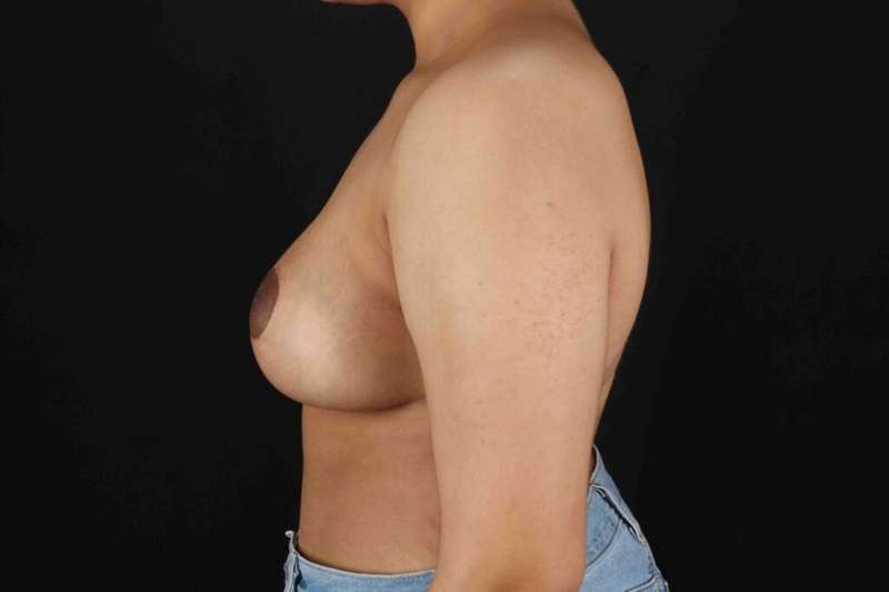 Breast Reduction with Lift Before & After Patient #1027