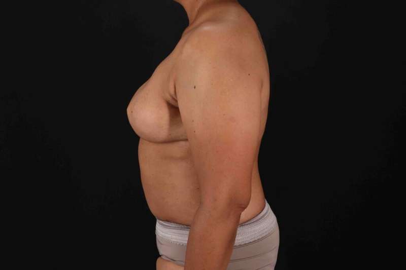 Breast Reconstruction Before & After Patient #1038