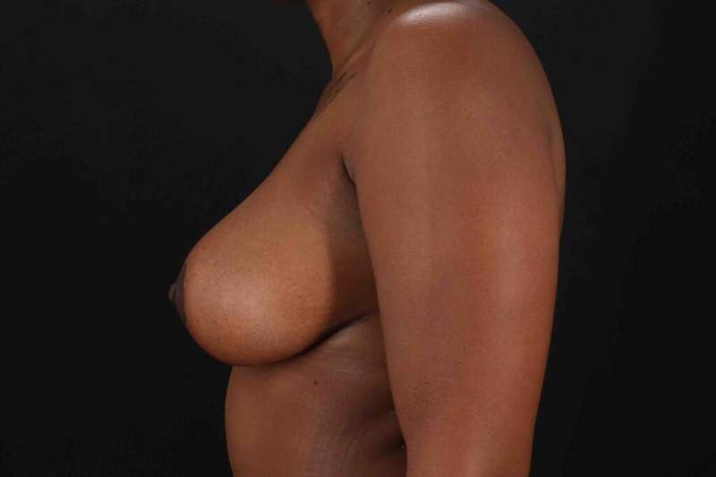 Breast Lift Before & After Patient #1049
