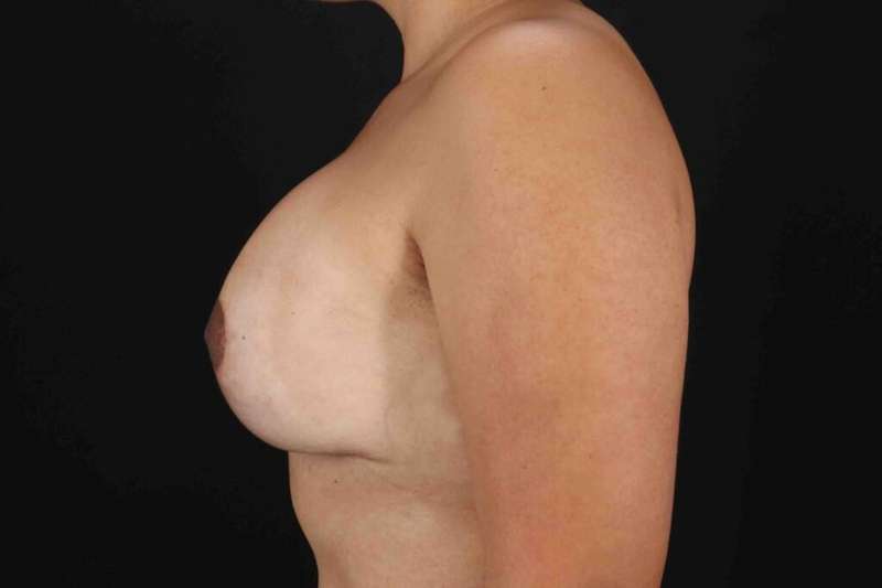 Breast Lift Before & After Patient #1082