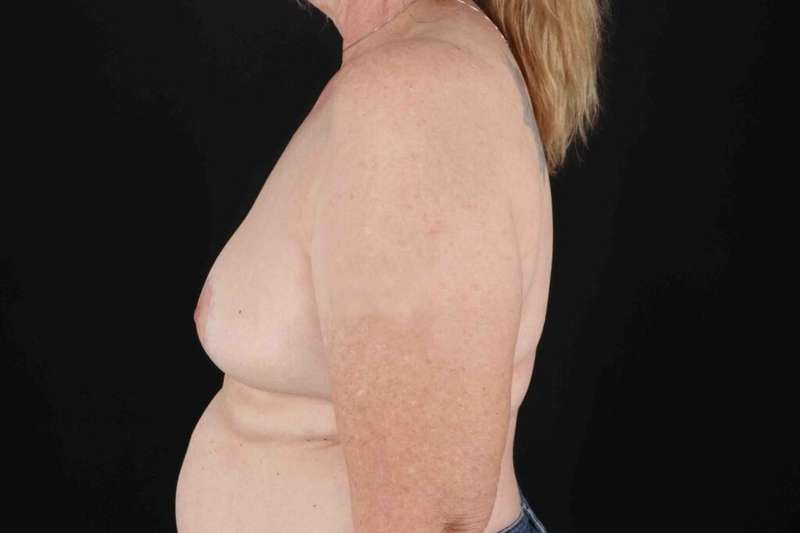 Breast Lift Before & After Patient #1181