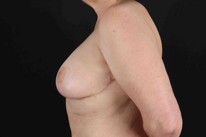 Breast Lift Before & After Patient #1192