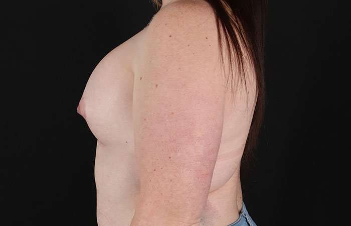 Breast Augmentation with Implants Before & After Patient #1258