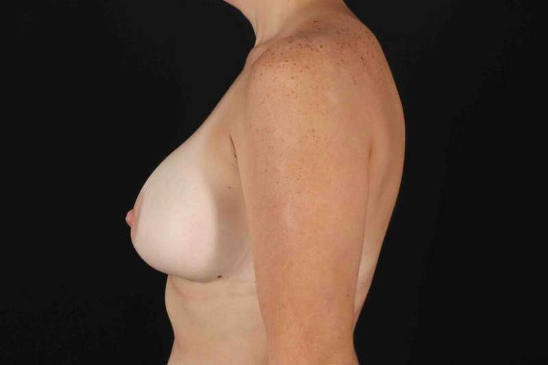 Breast Augmentation with Implants Before & After Patient #1269