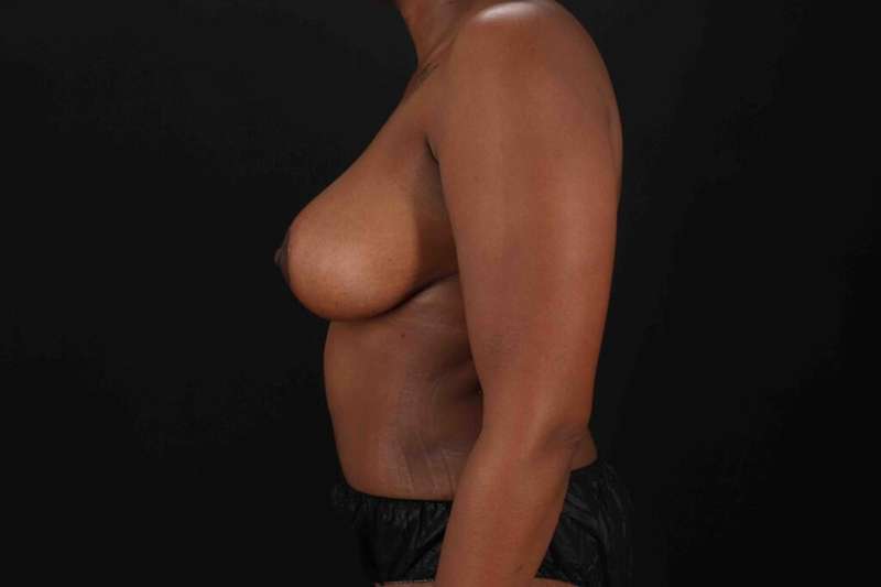 Tummy Tuck Before & After Patient #1451