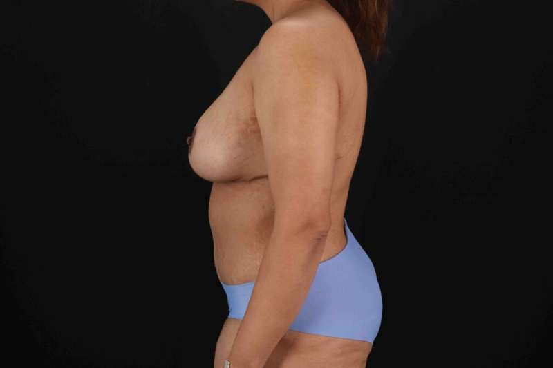 Tummy Tuck Before & After Patient #1464