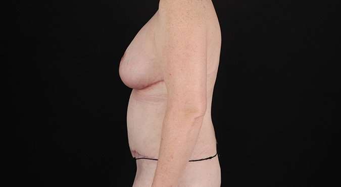 Tummy Tuck Before & After Patient #1477