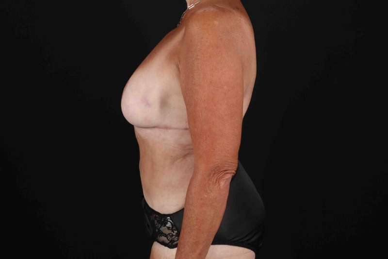 Tummy Tuck Before & After Patient #1515