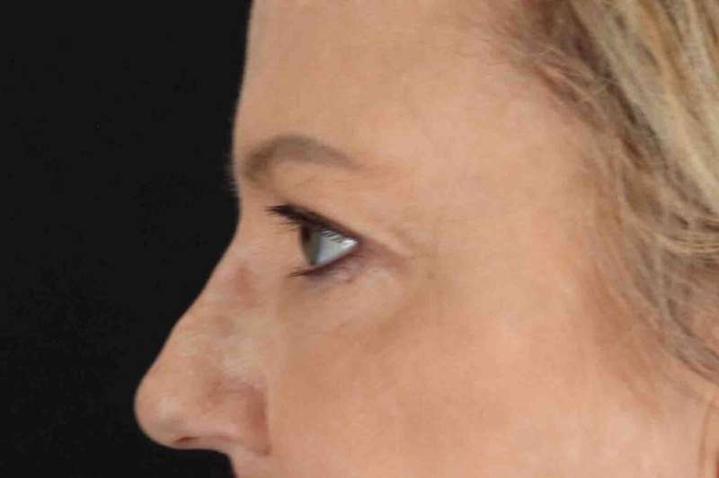 Brow Lift Before & After Patient #1577
