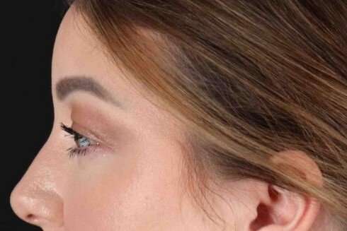 Brow Lift Before & After Patient #1588