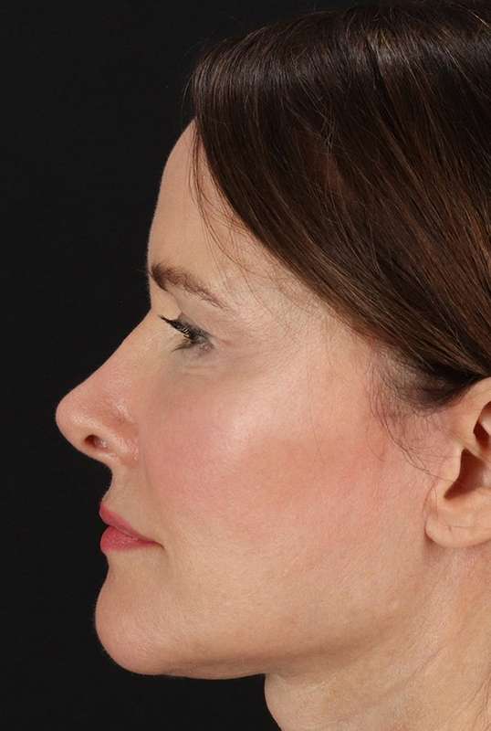 Neck Lift Before & After Patient #1698
