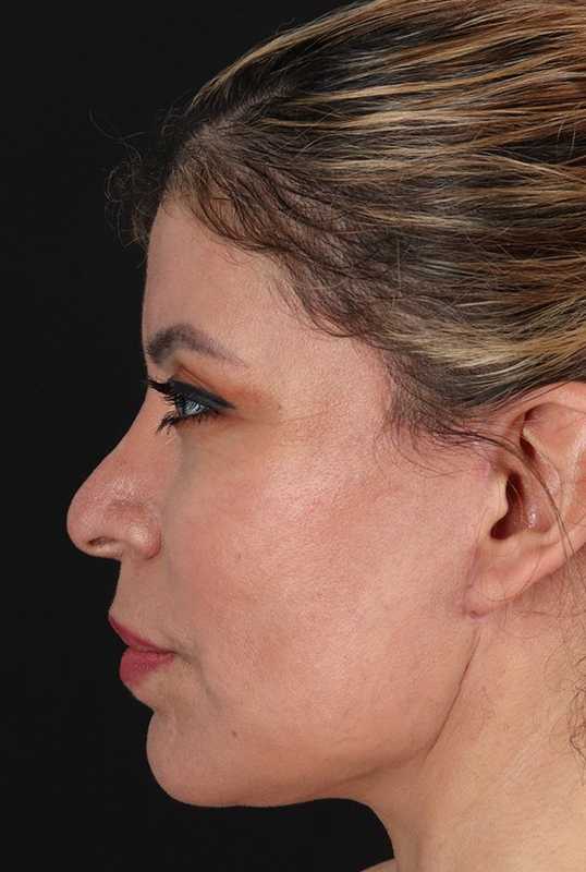 Neck Lift Before & After Patient #1709