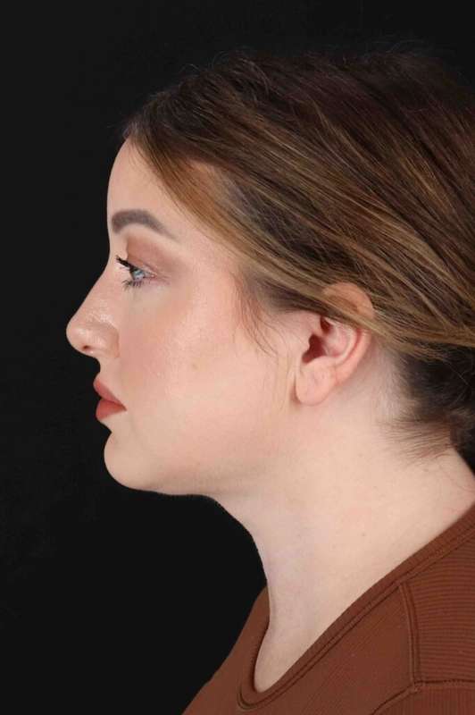 Neck Liposuction Before & After Patient #1742
