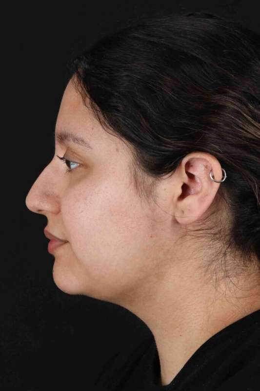 Neck Liposuction Before & After Patient #1753