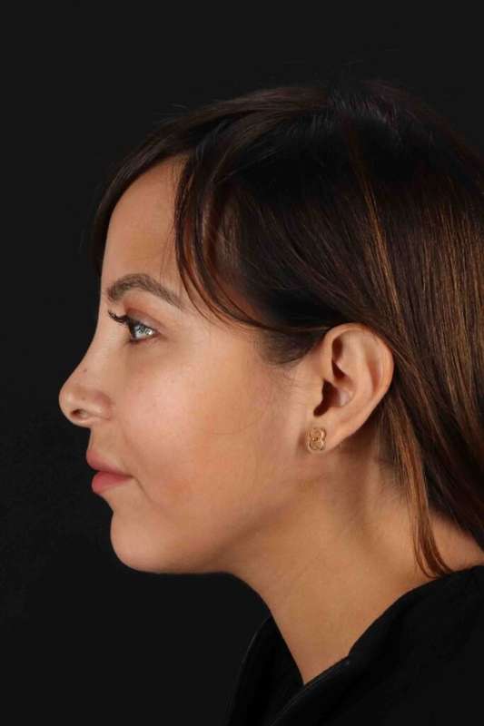 Neck Liposuction Before & After Patient #1764