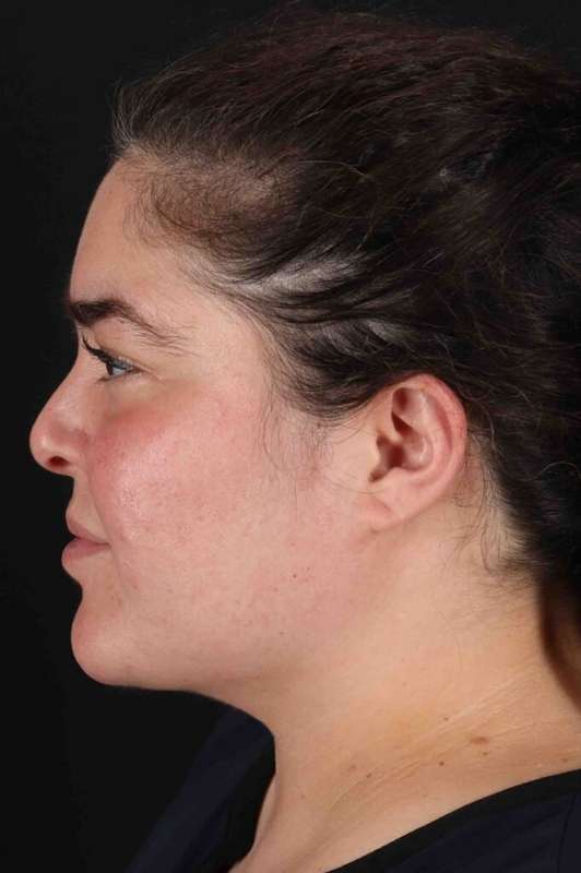 Neck Liposuction Before & After Patient #1775