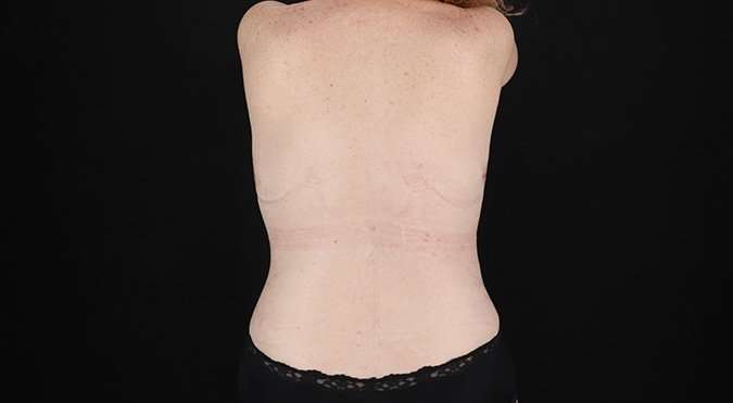 Tummy Tuck Before & After Patient #1477