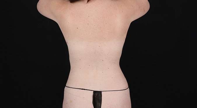 Tummy Tuck Before & After Patient #1504