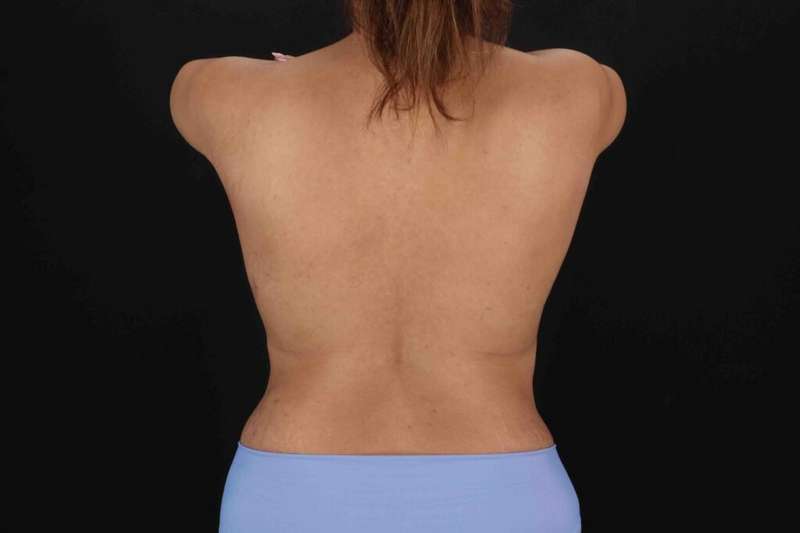 Tummy Tuck Before & After Patient #1464