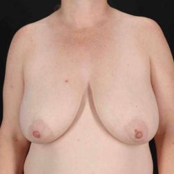 Breast Augmentation with Fat Transfer Before & After Patient #795