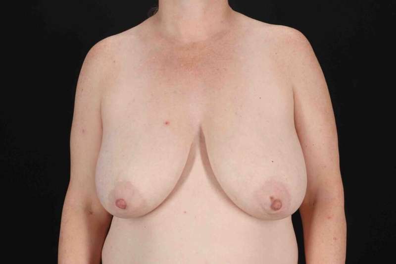 Breast Augmentation with Fat Transfer Before & After Patient #795