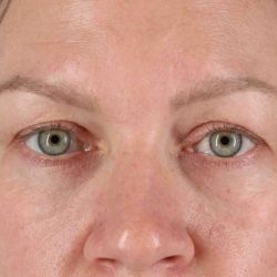 Eyelid Surgery Before & After Patient #1902