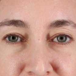 Eyelid Surgery Before & After Patient #1913