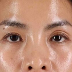 Eyelid Surgery Before & After Patient #1935