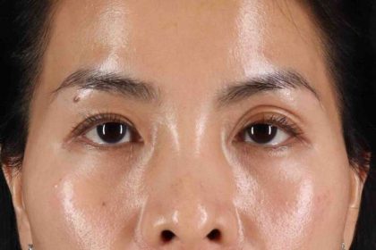 Eyelid Surgery Before & After Patient #1935