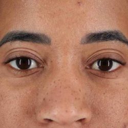 Eyelid Surgery Before & After Patient #1946
