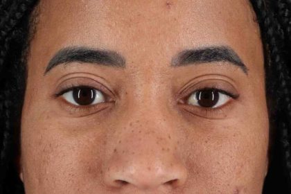 Eyelid Surgery Before & After Patient #1946