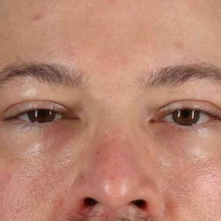Eyelid Surgery Before & After Patient #1957