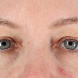 Eyelid Surgery Before & After Patient #1968