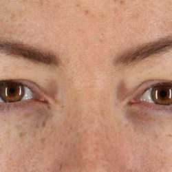 Eyelid Surgery Before & After Patient #1979