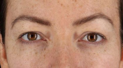Eyelid Surgery Before & After Patient #1979